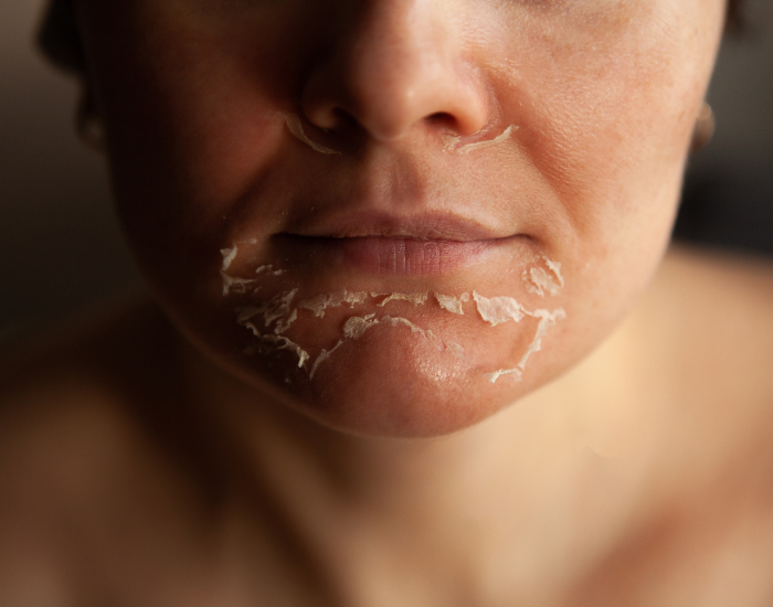 Chemical Peel Downtime: What’s Normal & What to Expect